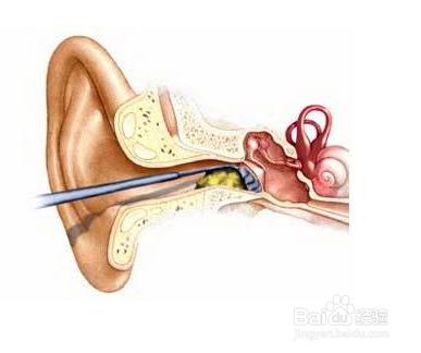 怎么样掏耳朵最干净，你知道耳屎有什么好处，该怎么清理