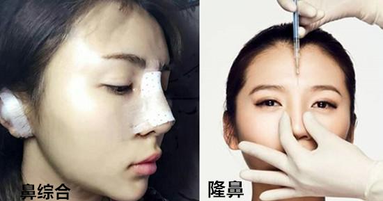 鼻综合手术拆线多少钱:鼻综合诊所拆线大概多少钱 鼻部整形中隆鼻和鼻综合整形具体有什么区别？