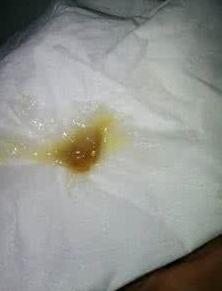 头条问答 - 咽炎,痰是暗黄色的,平时还能吃辣?抽烟吗?(5个回答)