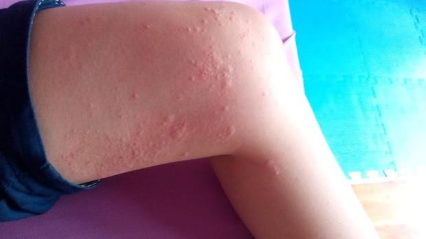 像荨麻疹这种皮肤病，会遗传下一代吗？