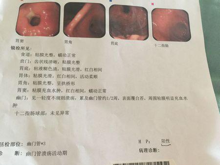 阴性与阳性:病毒检测阳性与阴性是依靠什么决定的？