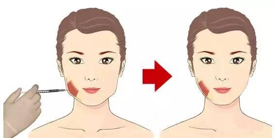 刘涛打瘦脸针面部凹陷，如何防止打完瘦脸针面部僵硬、凹陷？