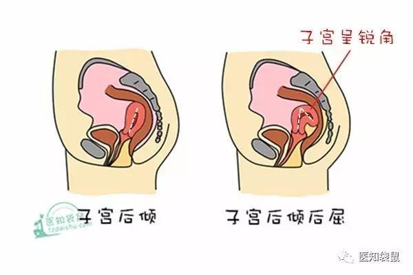 轻微盆腔炎治愈后能怀孕吗?轻微盆腔炎治疗后多久可以怀孕