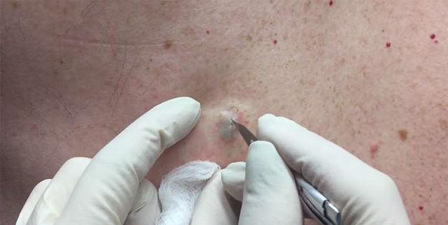 背后长痘痘怎么办后背长了很多痘痘和黑头能用粉刺针挤掉吗如何处理