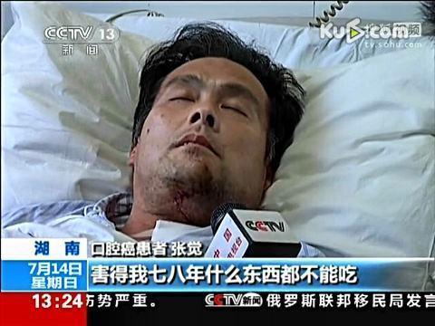 头条问答 男子划伤舌头竟患舌癌 口腔溃疡会癌变成舌癌 4个回答