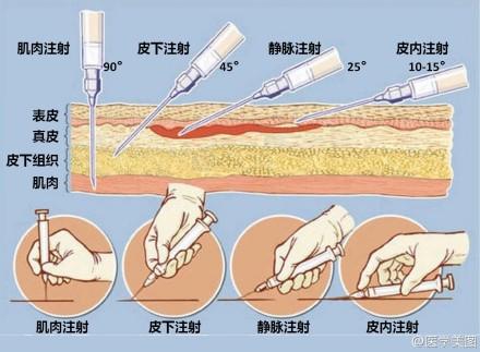 皮内皮下肌肉注射流程:皮下皮内肌肉注射缩写 打针或抽血的时候，针扎进去，会不会有一管肉在针头里？