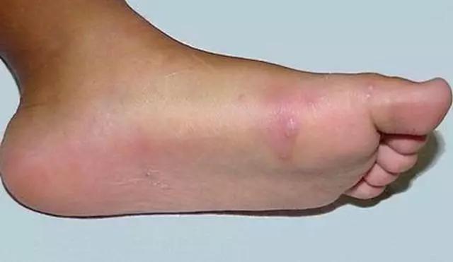 糖尿病有什么症状:糖尿病有什么症状和表现？