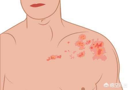 被称为缠腰龙的带状疱疹,缠满一圈人没救了吗？怎样能不留后遗症？