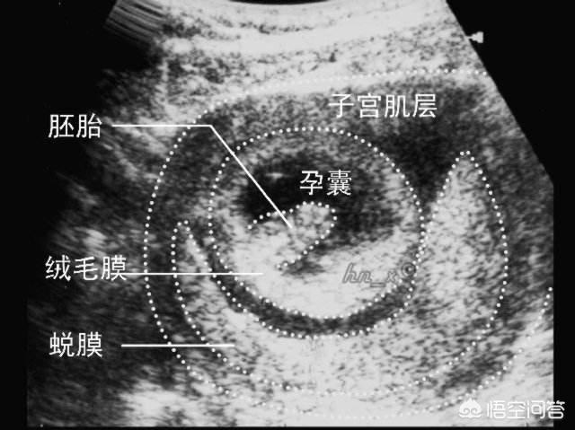 头条问答 怀孕四周可以看到孕囊吗 应该注意哪些事项 25个回答