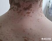 怎样才能嫁预防白癣风:白癜风患者如何避免同行反应？