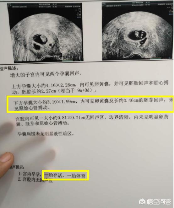 死胎有什么症状:如果死胎孕妇有什么反应 胎儿停止发育多久会自然流掉？