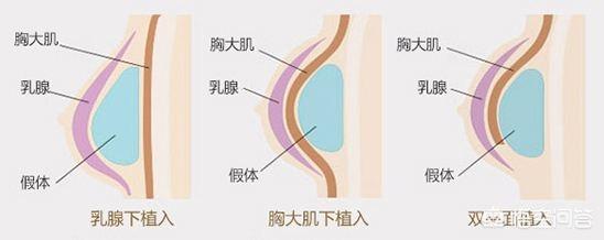 怎样丰胸;女人怎样快速丰胸最有效的方法