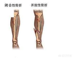 骨折的症状:骨折后不痛不肿可以下地吗？