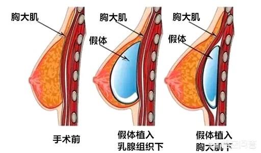 頭條問答 - 做了假體隆胸,留下的疤痕難看嗎?(9個回答)