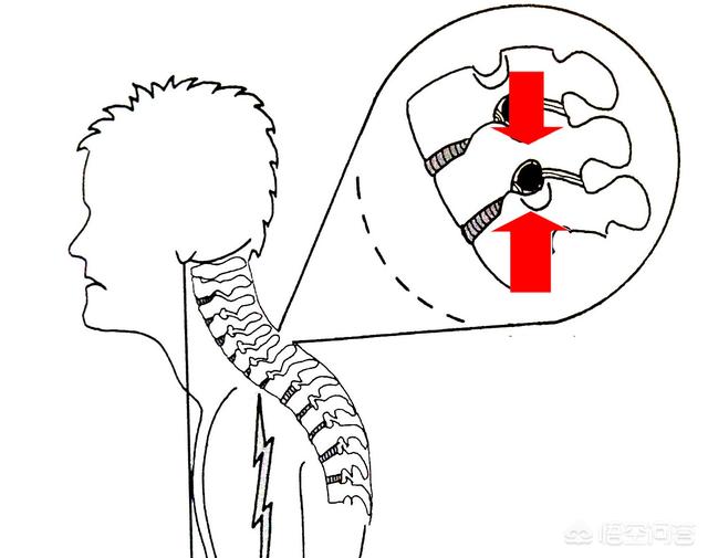 颈椎病患者适合睡啥样的枕头，颈椎病人应该选择什么样的枕头？