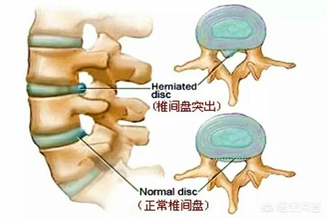 腰椎間盤突出本身並沒有明顯症狀,但當突出的椎間盤壓迫到周圍神經