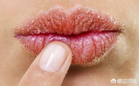 如何治疗唇炎,如何治疗唇炎最有效