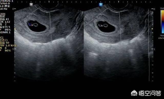 头条问答 怀孕四周可以看到孕囊吗 应该注意哪些事项 25个回答