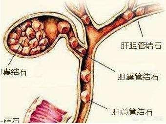胆囊炎的症状:胆囊不好的人，通常都有哪些感觉？
