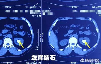 尿结石的治疗方法:1.6厘米的尿路结石怎么处理？