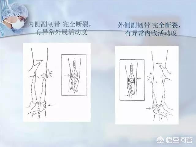 膝内侧副韧带断裂手术:膝关节侧副韧带损伤康复治疗？