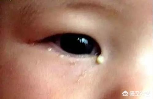 宝宝泪腺炎症状图片:宝宝两个月多了今天见他眼睛里有泪，这是咋回事？