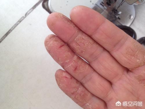 冬天手裂口子怎么办:冬天手容易裂,擦什么比较好?