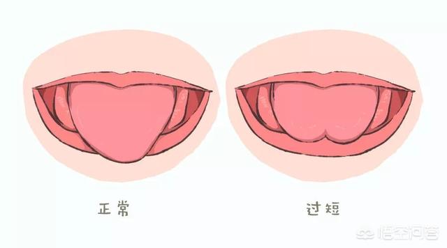 寶寶天生舌繫帶短對成長有影響嗎如要手術什麼時候最佳