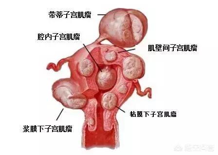 得子宫肌瘤什么东西不能吃:子宫肌瘤不能吃什么食物？