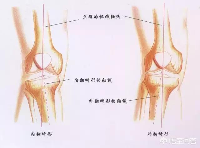 屁股外侧韧带拉伤怎么办:侧副韧带损伤会造成哪些问题？怎么治疗？