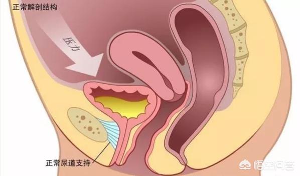 如何缩紧阴道:产后漏尿是病吗？严重吗？