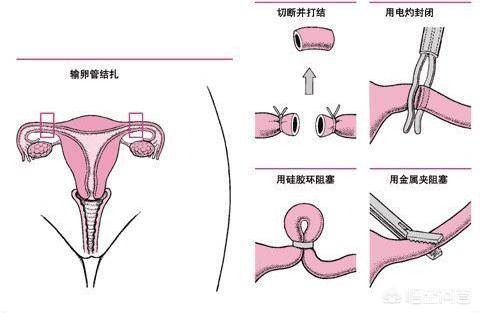 结扎什么意思,做结扎对女性有什么影响吗？