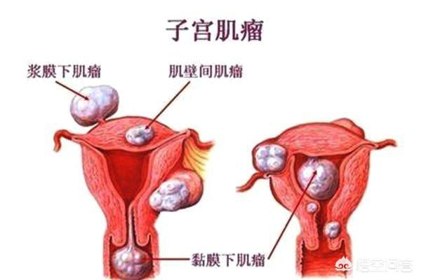 得子宫肌瘤什么东西不能吃:子宫肌瘤不能吃什么食物？