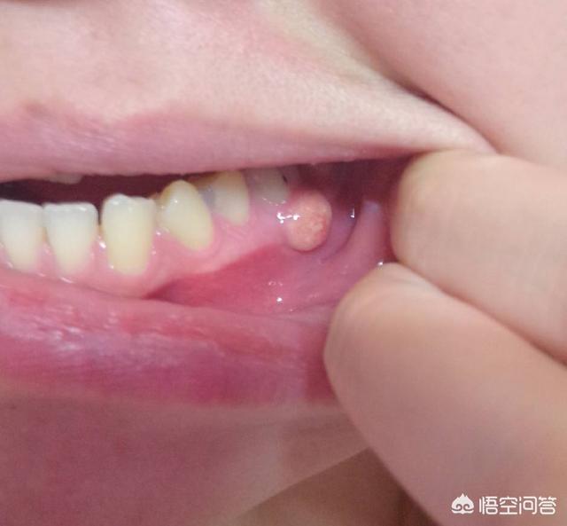 小孩牙龈上长了个包,里面好像有脓,该怎么办?-生活百科