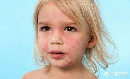 宝宝荨麻疹反反复复总不好，是什么原因？(孩子荨麻疹总是反复)