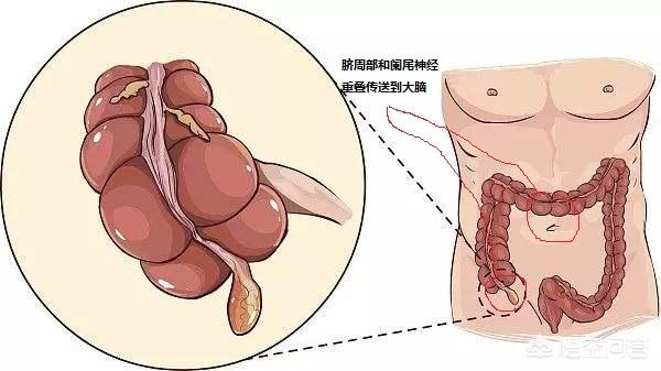 阑尾炎术后一痛就便血是什么原因,阑尾炎术后肚痛便血是什么原因