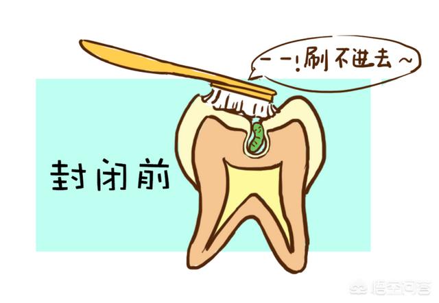 怎么预防龋齿的发生，孩子如何预防蛀牙涂氟跟窝沟封闭哪个效果更好