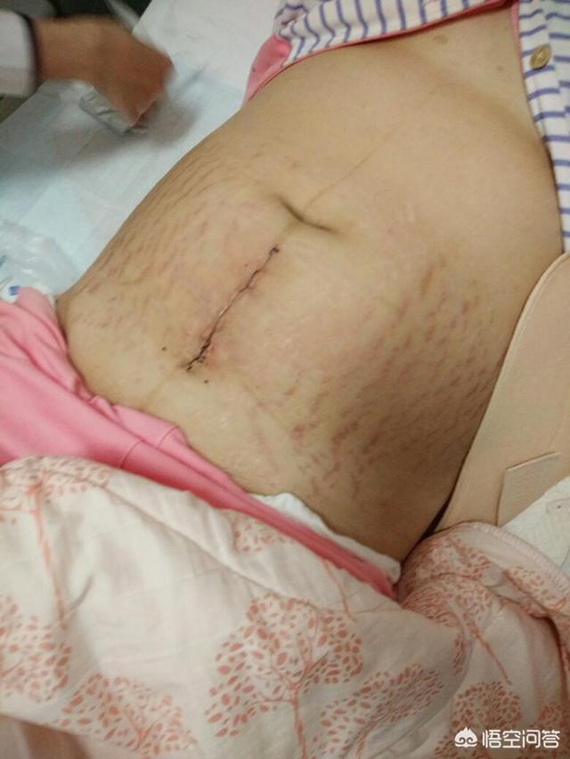 女朋友堕胎肚子疤图片图片