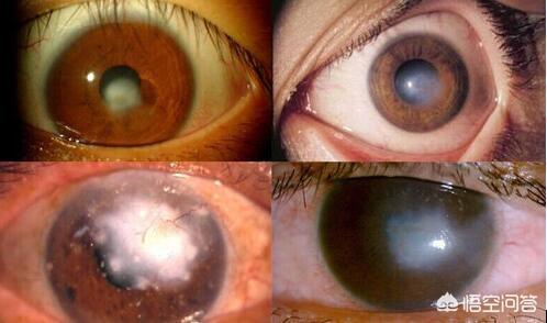 眼角膜白斑怎样用药治疗？(先天性眼角膜白斑的治疗)