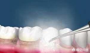 洗牙的好处和坏处:洗牙后牙齿更酸了，是不是洗牙有害啊？