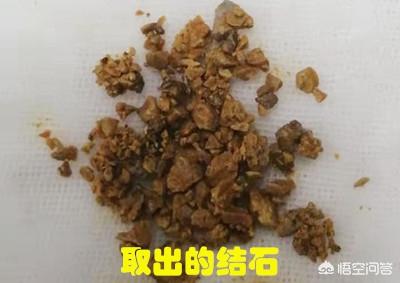 尿结石的治疗方法:1.6厘米的尿路结石怎么处理？