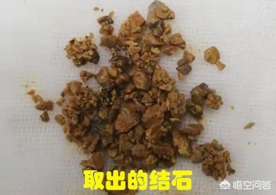 尿结石怎么治疗?尿结石怎么治疗最好的方法