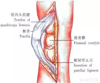 膑骨术练股四头肌:人工膝关节置换手术步骤？