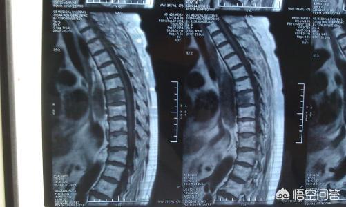 骨折的症状:骨折后不痛不肿可以下地吗？