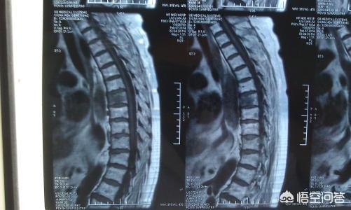 骨折的症状:骨折是一种什么样的体验？