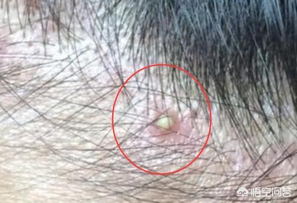 螨虫是什么:螨虫是什么引起的 螨虫是什么？它对头皮有什么危害？