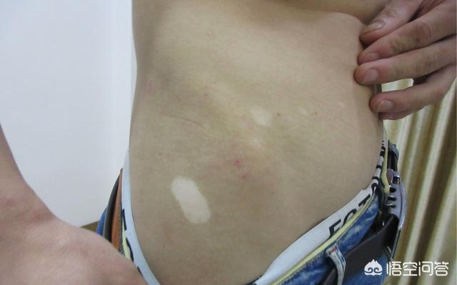 怎样才能嫁预防白癣风:白癜风患者如何避免同行反应？