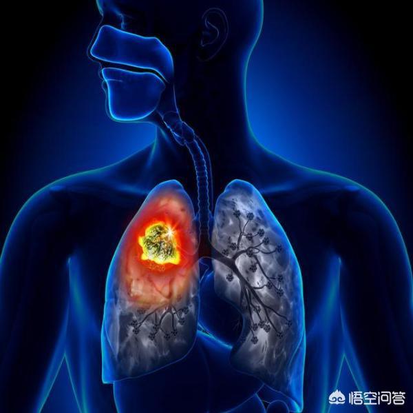 外周血是什么意思,外周血验肺癌到底靠谱吗？