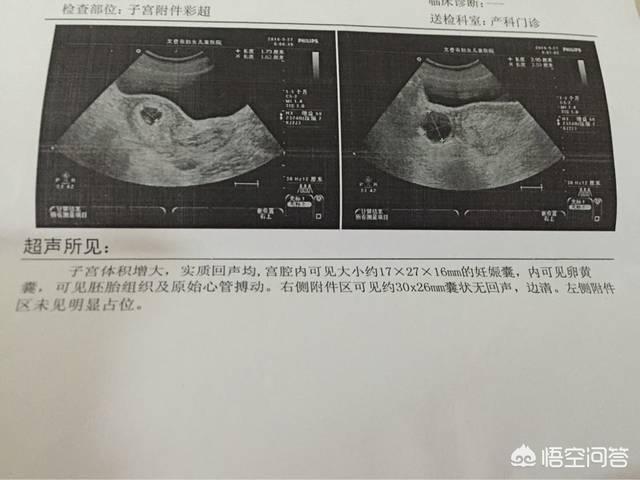 头条问答 怀孕四周可以看到孕囊吗 应该注意哪些事项 25个回答
