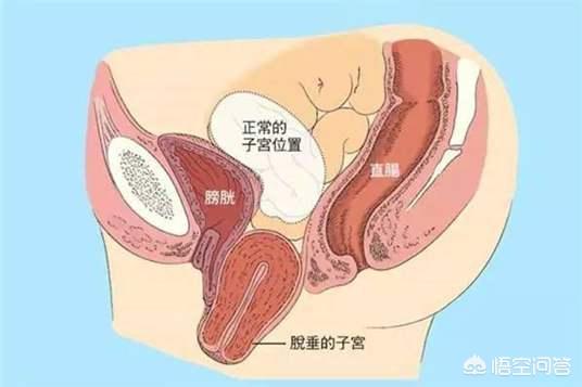 子宫脱垂的常见原因有哪些，妈妈被确诊子宫脱垂，什么是子宫脱垂？